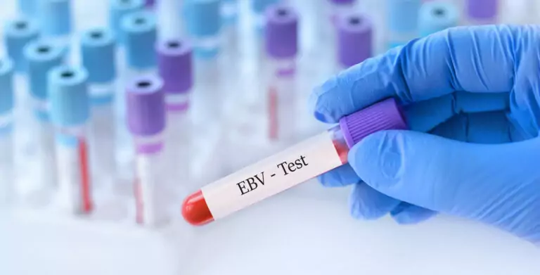 ¿Tiene el virus de Epstein-Barr un papel en la autoinmunidad?