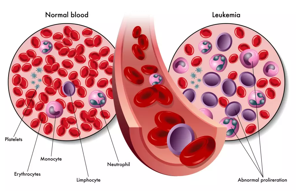 Leucemia y la respuesta inmunológica