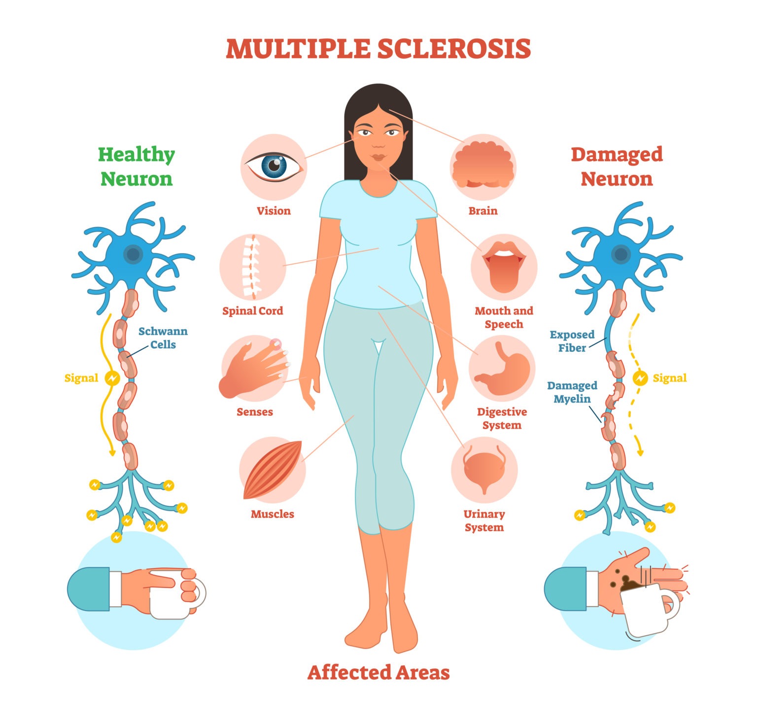 Esclerosis M Ltiple Una Enfermedad Del Sistema Nervioso   Multiple Sclerosis 192872586 1536x1461 